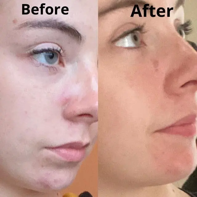 Argan Acne Rehab Serum 30ml | Plant-Based Formula for Acne-Prone Skin - Image 10